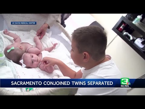 'Really happy babies': Sacramento twins conjoined by heads successfully separated