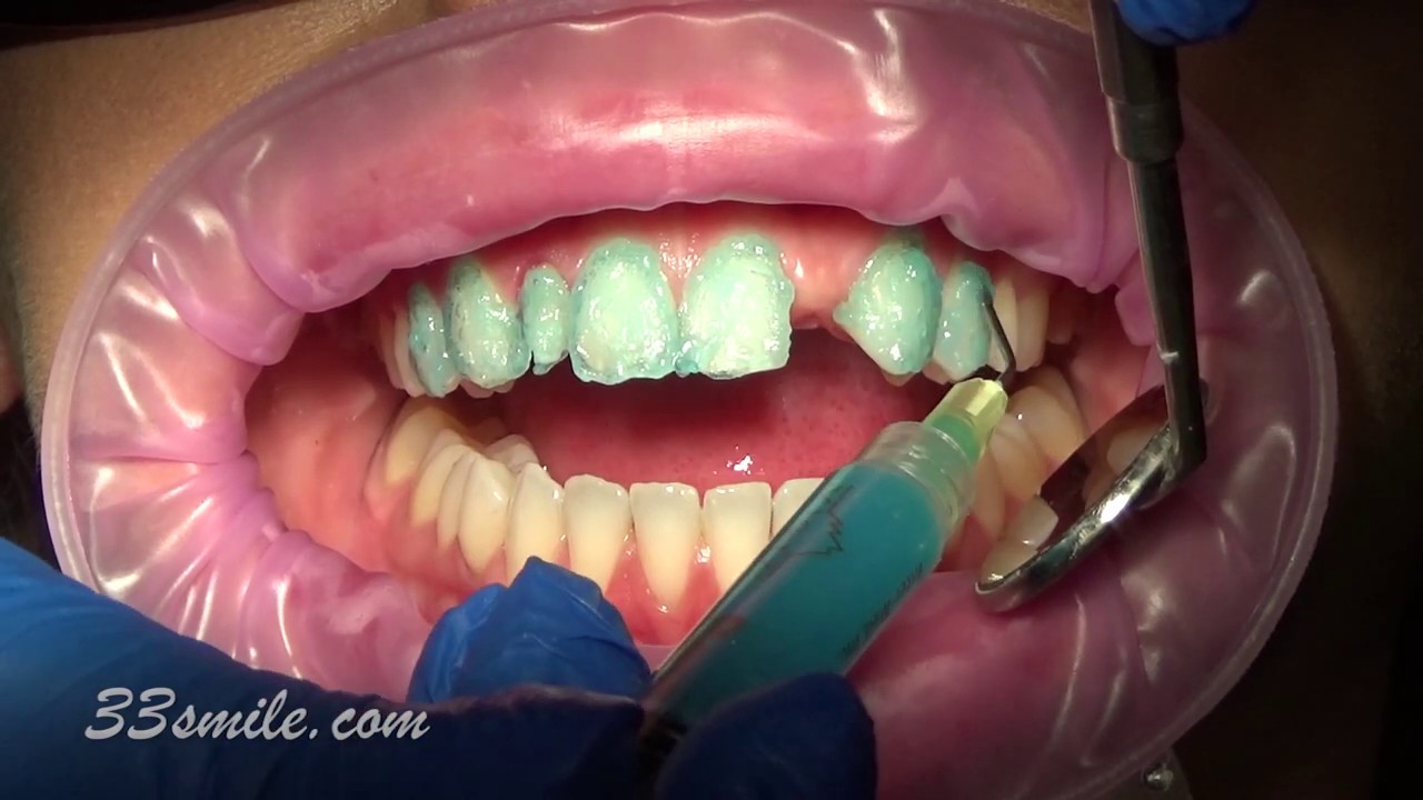 porcelain dental veneer bridge and veneers cosmetic ... porcelain dental veneer bridge and veneers cosmetic ...