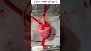 Open heart surgery short video viral
