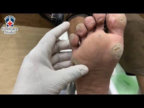 🔴 Live Foot Corn Removal | Real-Time Multiple Corns Extraction - YouTube