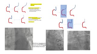 Amplatz L guide manipulations/videos- Other RCA guides and tips- The 5 RCA engagement caveats- Hanna