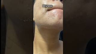 Tretinoin Dry Skin Wale Mat Lagao