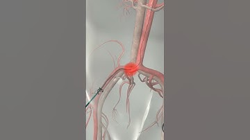 Learn How Cardiac Catheterization Works