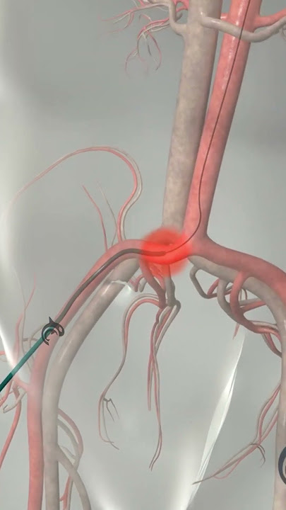 Learn How Cardiac Catheterization Works