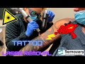 Does tattoo removal hurt? (a day in the life)