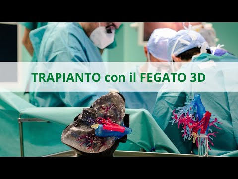 Trapianto di fegato preparato con la stampa in 3D dell'organo