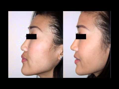 Video thumbnail: Asian Female Rhinoplasty NYC Before & After Facial Plastic Surgeon Dr. Sam Rizk · Dr. Sam Rizk