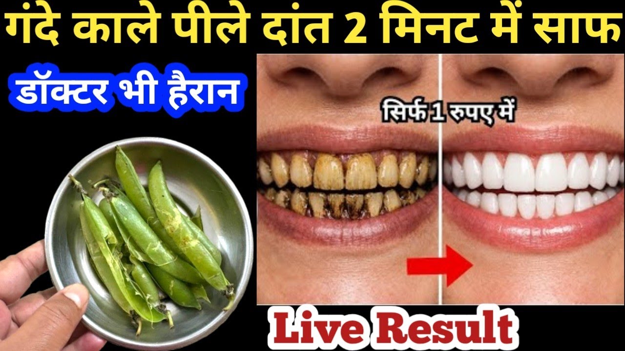 सिर्फ 2 मिनट में गंदे सड़े पीले दांतो को मोती की तरह चमका देगा / Teeth whitening remedy 