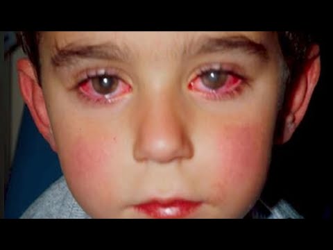 Young Boy Will Lose 75% Of His Eyesight Because Of Small Toy You Probably Have In Your House!