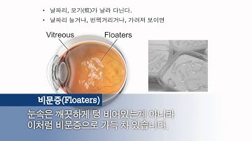 송탄성모안과 비문증 날파리증 망막박리 망막열공 망막원공