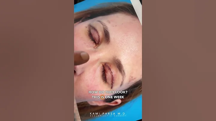 Healing After Upper Blepharoplasty For Hooded Upper Eyelids | Dr. Kami Parsa