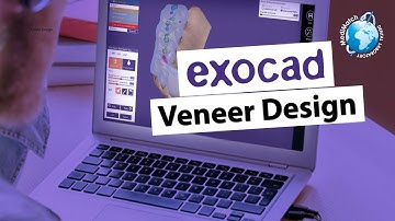 Exocad Veneer Design in minutes
