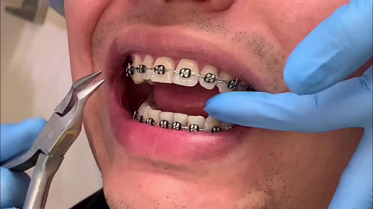 Como retirar aparelho ortodôntico? YouTube