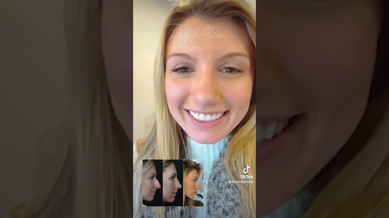 2 Weeks After Rhinoplasty! Look At My Happy Patients!
