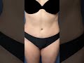 Tummy Tuck &amp; Lipo: The Ultimate Stomach Transformation