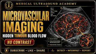 Microvascular Imaging Masterclass Detecting Hidden Tumour Blood Flow Without Contrast