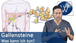 Gallensteine: Was nun? Typische Symptome, Alles zur Entstehung & Tipps zur natürlichen Entfernung