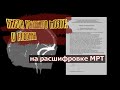 Арахноидальная ретроцеребеллярная КИСТА ГОЛОВНОГО МОЗГА У РЕБЕНКА на расшифровке МРТ головного мозга