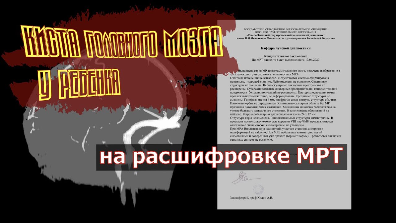 Арахноидальная ретроцеребеллярная КИСТА ГОЛОВНОГО МОЗГА У РЕБЕНКА на ...