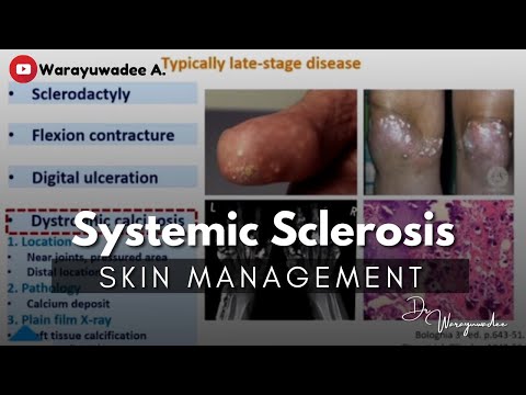 Systemic Sclerosis-related Skin Management | Aug 20, 2021