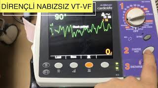 Defi̇bri̇lasyona Di̇rençli̇ Vf-Nabizsiz Vt Vakasi Defi̇bri̇lasyon Pace Pedleri̇ İle Yapildi