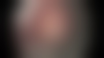 PADLOCK CLIP™ Defect Closure System - Endoscopic Closure of an Esophageal Perforation