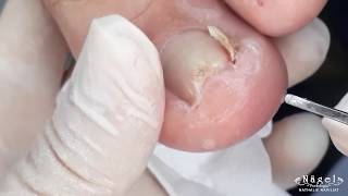 UNHA ENCRAVADA COM ESPÍCULA PROFUNDA | EXTREMELY DEEP  INGROWN TOENAIL #ingrowntoenail #nails