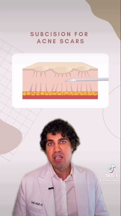 Learn More About Subcision Treatment for Acne Scars By Dr. Nadir Qazi