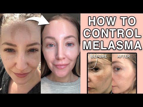 How to treat melasma at home and with mini fraxel
