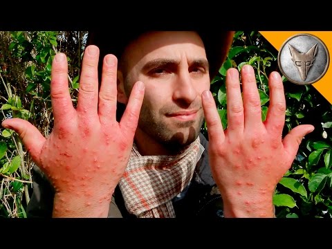 Worst Insect Stings EVER!