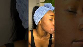 Chemical Peel | Before and After | 50% Glycolic Acid Chemical Peel At Home