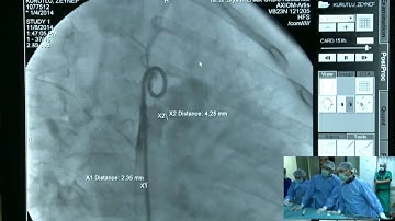 LIVE CASE 18  PDA closure with Coccoon duct occluder Metin Sungur, Abdullah Erdem