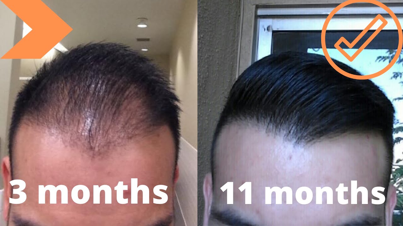 When To Expect Growth After A Hair Transplant *My Timeline - YouTube