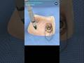EYE SURGERY 3D