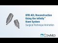 BTB ACL Reconstruction Using the Infinity™ Knee System - CONMED Animation