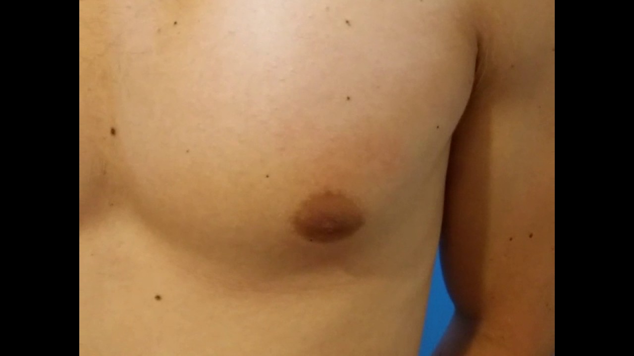 Droopy Nipple Steroid 💉💪Induced Gynecomastia Gland Removal By Dr.  Lebowitz, Long Island New York 
