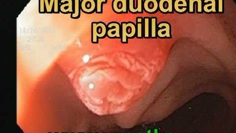 Major duodenal papilla.  Endoscopic video.