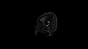 Improving sharpness and SNR in 3D CUBE FLAIR using AIR Recon DL