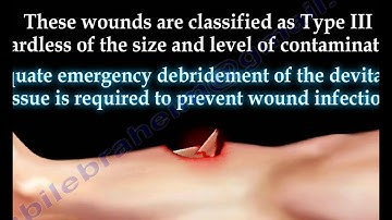 Open Fractures - Everything You Need To Know - Dr. Nabil Ebraheim