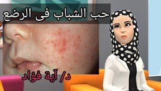 حب شباب للرضع أو حديثى الولادة !! 👍 حواديت عيادة الجلدية  Neonatal Acne