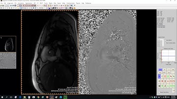 How to measure CMRI flow sequences by Segment?