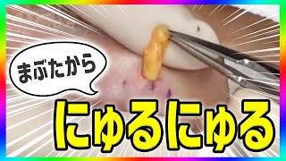 まぶたから、にょろにょろ【閲覧注意　手術動画】まぶたの脂肪を取る動画  Eyelid fat removal 日本整容手术