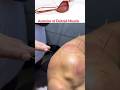 Deltoid Muscle Pain ''Dry needling ''#youtube #viral #exercise #therapy #ytshort #pain #hospitalcare