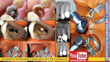 ENDODONTIC Retreatment one curve micromega gutta percha removal rebilda DC