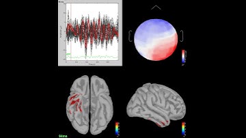 EEG 3D NewSubject Baseline avgref artrej   1 s epochs Avg Baseline avgref artrej   1 s epochs wMNE E