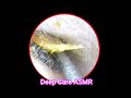 ASMR Ear Cleaning | Guaranteed Tingles and Instant Relaxation