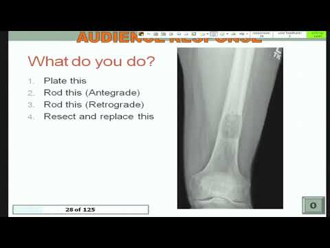 Management of pathological fractures