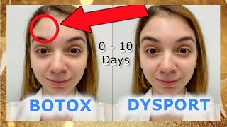 Botox Vs Dysport - Before and After