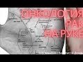 Онкология, рак на руке. Болезни на ладони. Не пугайтесь! Хиромантия