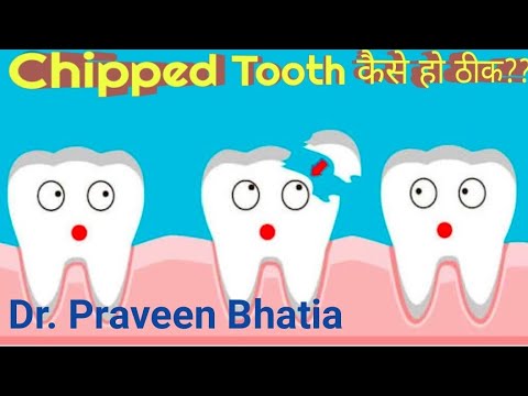 FIX  CHIPPED TEETH COSTING-दाँत भूर जाएँ तो उपाय और खर्चा कितना -Dr.Praveen Bhatia